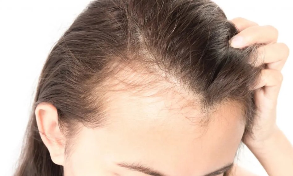 How Hair Scalp Micropigmentation Can Benefit Women